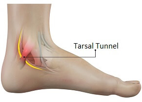Tarsal Tunnel Syndrome causes foot pain, tingling and numbness underneath the foot and on the inner ankle. Learn about causes, symptoms, diagnosis & treatment