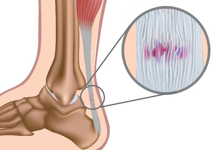 sharp pain in the back of my heel