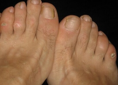 bunions corns calluses