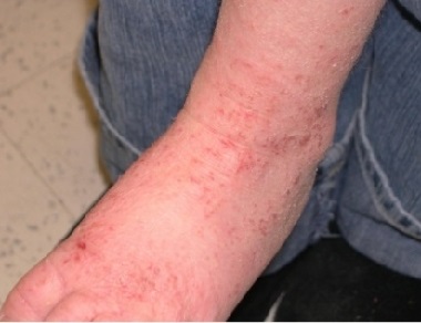 Atopic dermatitis is the most common type of foot eczema. Find out all about the common causes, symptoms and treatment options. Atopic dermatitis is the most common type of foot eczema. Find out all about the common causes, symptoms and treatment options.