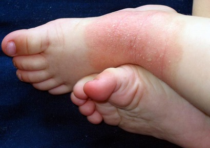 Foot Eczema: Causes, Symptoms & Treatment - Foot Pain Explored