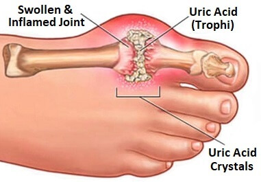 Foot Gout Podagra Treatment Prevention Foot Pain Explored