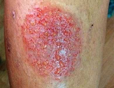 Nummular eczema presents as coin-shaped lesions on the skin Nummular eczema presents as coin-shaped lesions on the skin