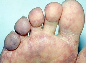 Blue Toe Syndrome: Causes foot pain and discoloration. Symptoms, diagnosis & treatment