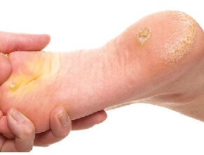 Foot Corns & Calluses: Find out what they are, how they are different and how to treat them