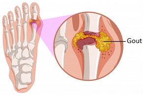 Gout most commonly affects the foot. Check out these simple ways to prevent gout attacks