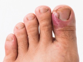 An ingrown toenail develops when the curled sides of the nail push into the surrounding skin caused toe pain and inflammation
