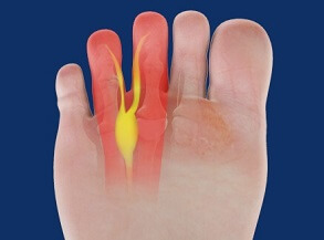 Morton's Neuroma causes pain, tingling and numbness in the foot Morton's Neuroma causes pain, tingling and numbness in the foot