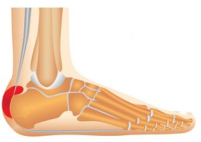 Heel Bursitis: Causes foot pain and swelling. Find out how to treat it fast.
