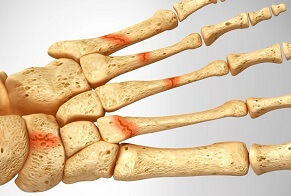 Foot Stress Fractures: Common causes of foot pain. Find out about the symptoms, causes, diagnosis & treatment options