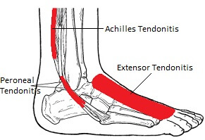 Tendonitis - Inflammation & Degeneration of the Foot Tendons: Causes, symptoms, diagnosis & treatment
