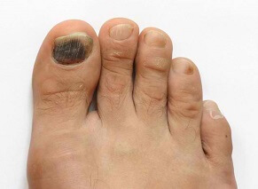 Tennis Toe aka Runners Toe or Subungual Hematoma: Causes, Symptoms, Diagnosis & Treatment