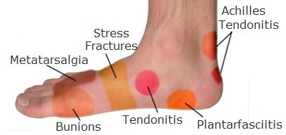 Foot Pain Diagnosis: What's Causing Your Pain