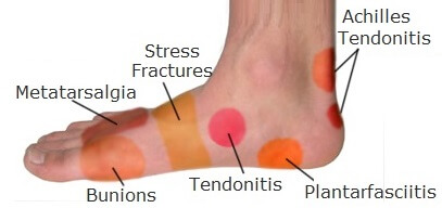 tendonitis bottom of foot