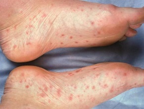 Foot Rashes: Are they serious or not? Find out everything you need to know