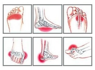 Foot Pain Diagram Why Does My Foot Hurt