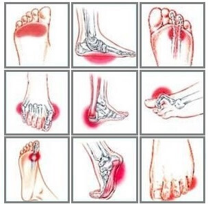 Neuropathy Care In Plano Dallas Prosper Tx Graff Foot Ankle And Wound Care