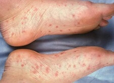 Foot Eczema: Causes, Symptoms & Treatment - Foot Pain Explored