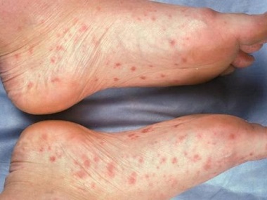 Tick sikkerhed lindring Foot Rash: Causes, Symptoms & Treatment