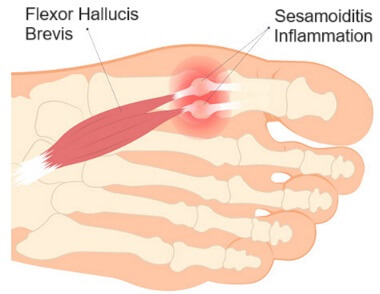 Sesamoiditis: Find out how it causes foot pain