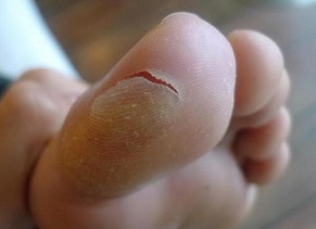 Blisters are a common cause of pain in toes