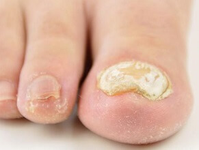 Thick Toenails: Learn about common causes, symptoms and the best treatment options