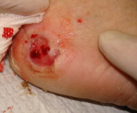 Diabetic peripheral neuropathy can often lead to the formation of ulcers
