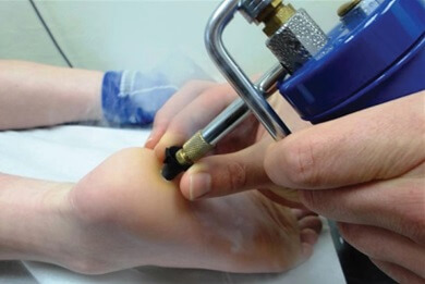 Freezing A Verruca Off: How to freeze a plantar wart Freezing A Verruca Off: How to freeze a plantar wart