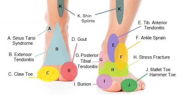 Heel and foot pain : r/trailrunning