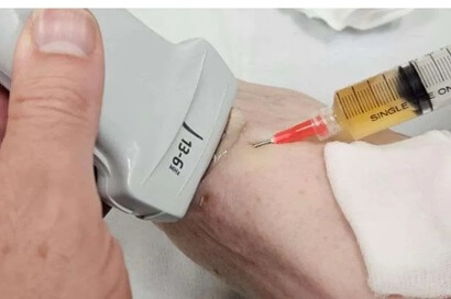 Ganglion Cyst Foot Causes Treatment Ganglion Cyst Foot Causes Treatment