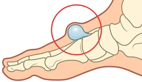 Ganglion Cyst Foot: Causes, symptoms, diagnosis and treatment of this common cause of foot lumps Ganglion Cyst Foot: Causes, symptoms, diagnosis and treatment of this common cause of foot lumps