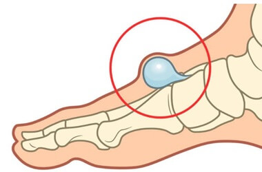 Lump On Top Of Foot: Common Causes & Treatment