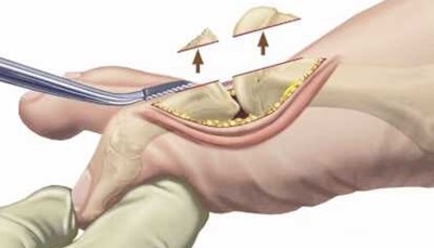 Hallux Rigidus Surgery: Cheilectomy