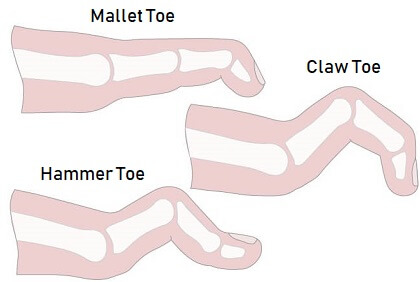 Mallet Toe, Hammer Toe & Claw Toe - Causes, Symptoms & Treatment