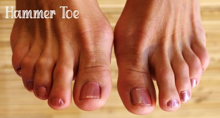 What Is Hammer Toe? Causes, Symptoms, Diagnosis and Treatment of Hammer Toe What Is Hammer Toe? Causes, Symptoms, Diagnosis and Treatment of Hammer Toe