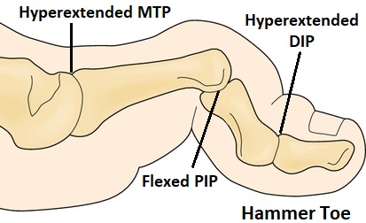 Hammer Toe: Flexion at the PIP joint leads to hyperextension at the MTP and DIP resulting in an abnormally curled toe Hammer Toe: Flexion at the PIP joint leads to hyperextension at the MTP and DIP resulting in an abnormally curled toe