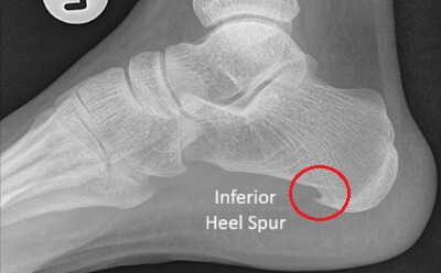 Hard Bump On Bottom Of Foot: Bone Spurs - causes, symptoms & treatment