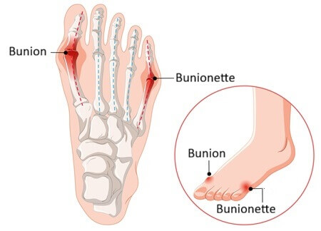 bunion bunionette 450 opt feb 26