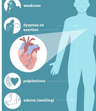 Symptoms of Heart Failure: foot and ankle swelling, shortness of breath, palpitations, weakness & confusion, persistent cough, increased urination