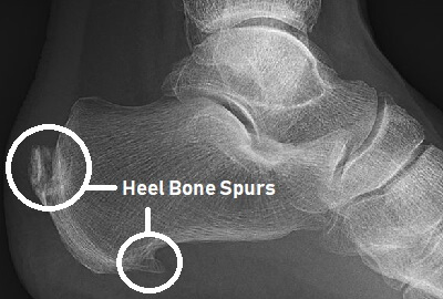 Heel Bone Spurs: Causes, Symptoms & Treatment - Foot Pain Explored