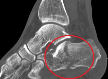 Calcaneal fractures are a serious cause foot heel pain