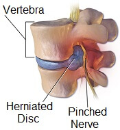 A slipped disc can cause numb feet