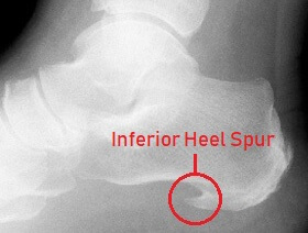 Hard Bump On Bottom Of Foot: Bone Spurs - causes, symptoms & treatment Hard Bump On Bottom Of Foot: Bone Spurs - causes, symptoms & treatment