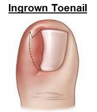 Diagram of an Ingrown Toe Nail