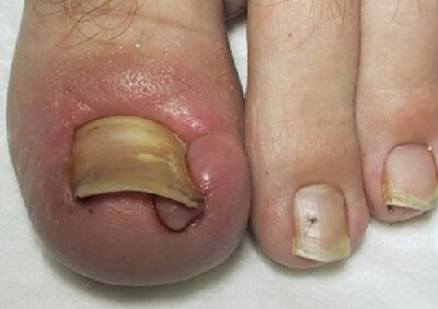 Epsom Salt for Toenail Fungus: The Miracle Cure You Need?