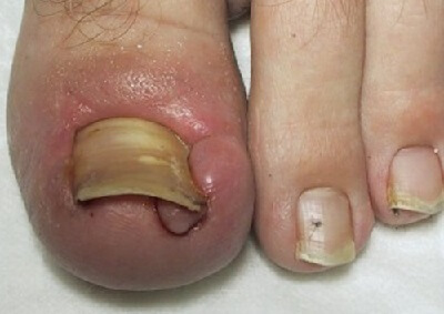 Ingrown Toenail Treatment, Causes & Prevention - Foot Pain Explored