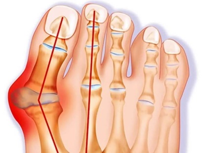 Lump & Pain On Inner Side Of Foot: Bunions. Causes, symptoms, diagnosis and treatment of pain on inside of foot