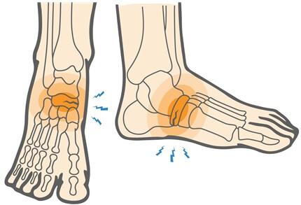 Inner Side Of Foot Pain: Navicular Stress Fracture. Causes, Symptoms, Diagnosis & Treatment of inner foot pain