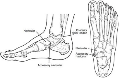 Lump On Side Of Foot: Bunions. Causes, symptoms, diagnosis and treatment of pain on inside of foot