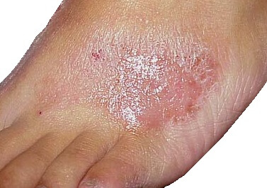 dry itchy skin on bottom of feet